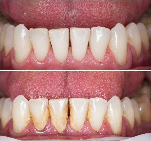 Teeth Cleaning (Scaling & Polishing)